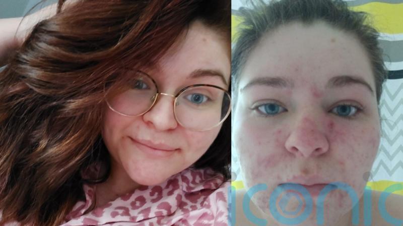 Mum-of-two who became a recluse due to pregnancy-induced acne now feels ‘free’ thanks to ‘life-changing’ cure