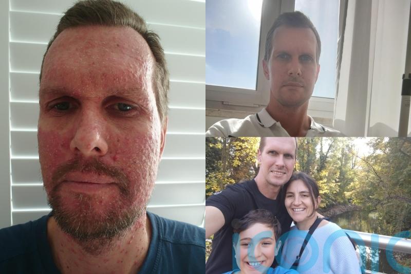 Dad with cancer who looked like the ‘Nightmare on Elm Street’ after chemo now hopes German vaccine can save his life