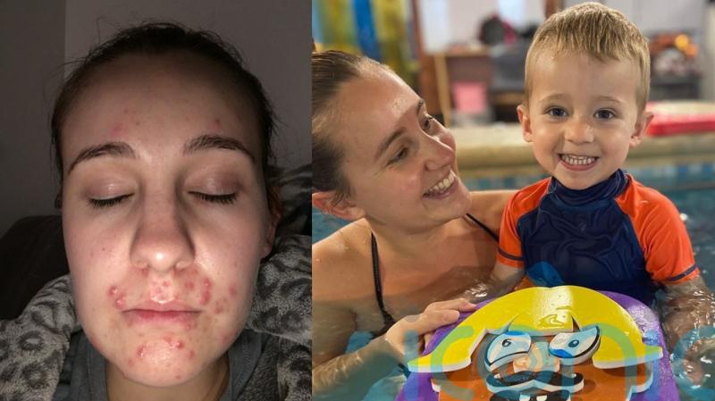 Mum who was too embarrassed to take her son swimming due to acne celebrates her clear skin with a trip to the pool