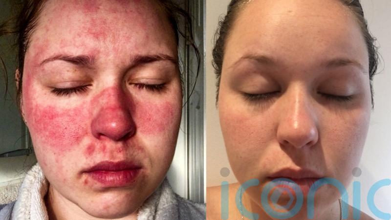 A mum-to-be who found it hard to put her face on her pillow due to red sore patches has regained her confidence