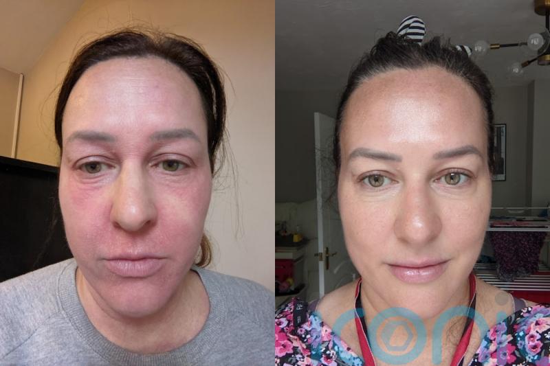 Mum whose eczema felt like ‘torture’ and made her ‘hate herself’ has since healed her skin and is enjoying life again