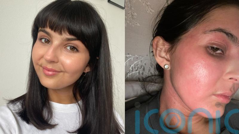 Woman who spent last Christmas with skin condition too painful to sleep now feeling festive after ‘unbelievable’ fix