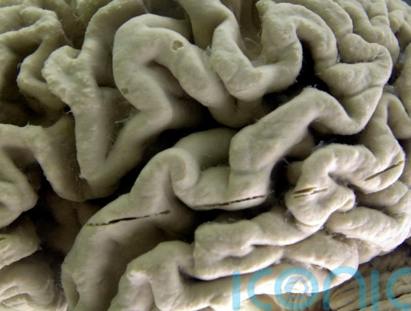 US approves Alzheimer’s drug that can slow disease’s progress