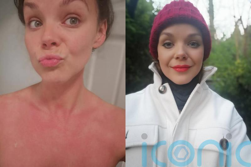 Carer allergic to cold told she looks like a &lsquo;monster&rsquo; due to skin&rsquo;s red and blotchy reaction to low temperatures