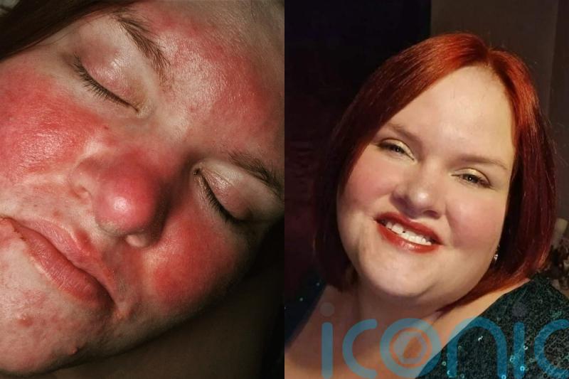 Woman with rosacea who was branded ‘a tomato’ and endured cosmetic surgery jokes from her ex has found a miracle cure