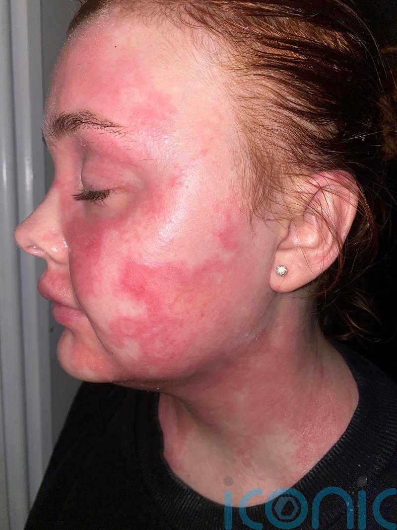 Woman whose face swelled due to topical steroid withdrawal says condition was so painful she could barely open her eyes