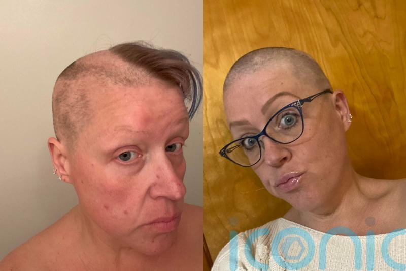 Teacher with trichotillomania who spent hours a day pulling hairs now embracing new look as ‘bald, beautiful woman’