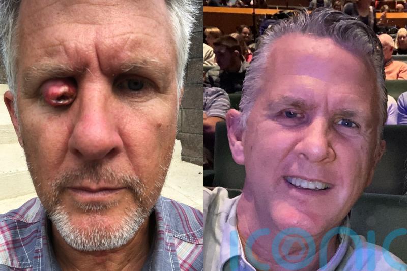 Dad at risk of losing sight after cancerous eyelid tumour swelled to ‘size of cherry tomato’ praises Specsavers and NHS