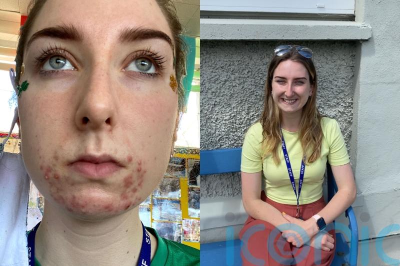 Teacher whose ‘beard of spots’ from wearing Covid masks sent ‘shiver down the spine’ of her pupils finds AI solution