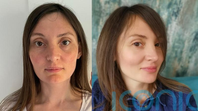 Mum who fled Ukraine with daughter says it ‘aged her many years’ but lip and cheek fillers are helping her move forward