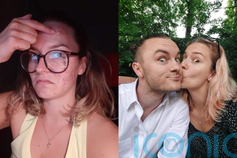 Woman with ‘terrible’ acne who feared she would never find love now in happy relationship and has found AI skin solution