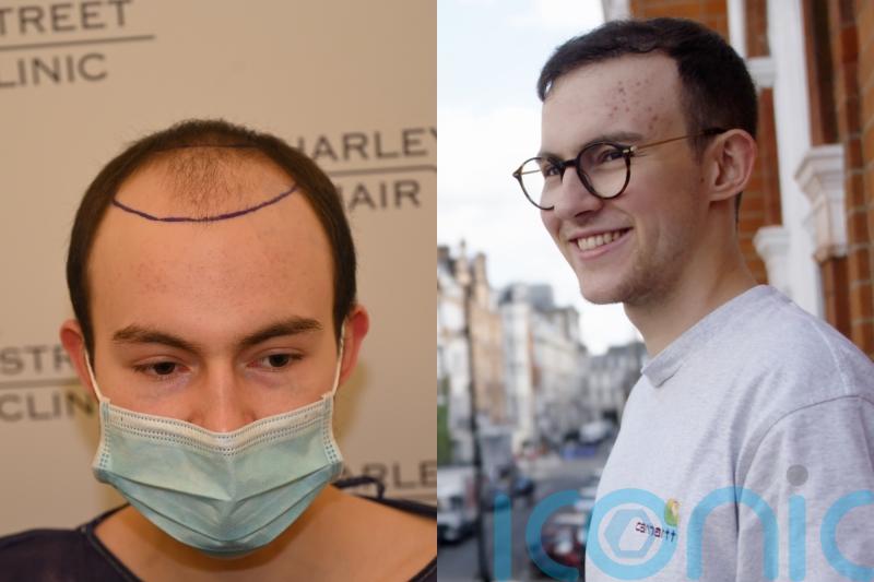 Student who struggled with depression due to receding hairline aged 16 feels he can ‘do anything’ after hair transplant