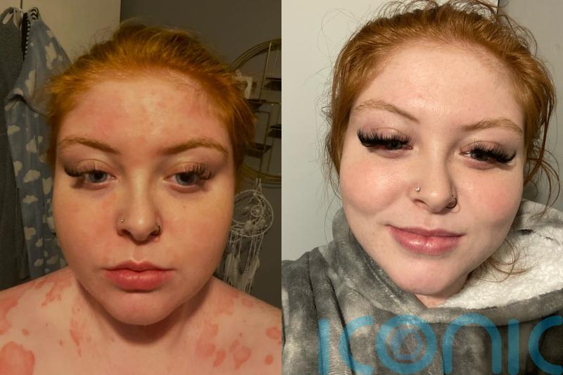 Woman who developed psoriasis all over her body due to trauma of being sexually abused has found a ‘miracle’ cure