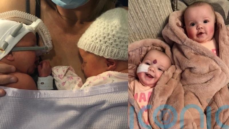 Mum who turned down abortion for twin daughter celebrates tot’s remarkable recovery after major surgery a few hours old