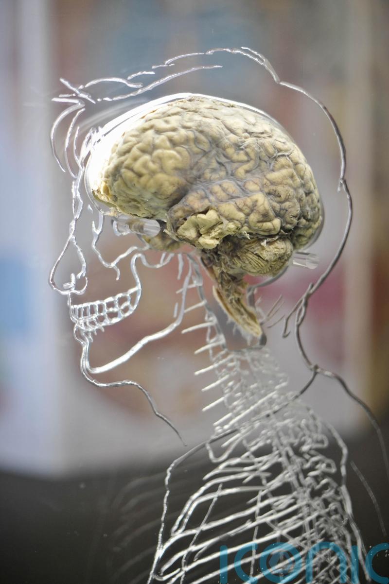 ‘45% of people with concussion show brain injury symptoms six months later’