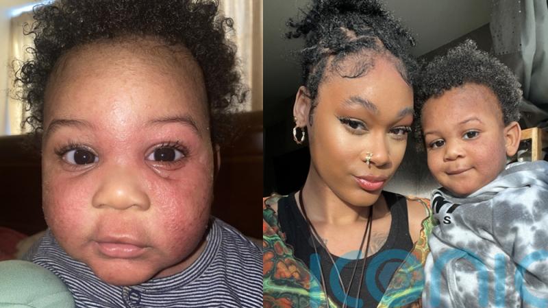 Baby who itched until he ‘bled all over the bed’ due to steroid withdrawal and severe eczema cured by high street cream