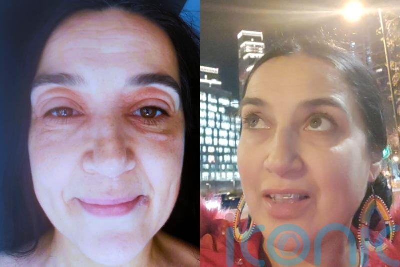 Woman who looked like a ‘toad’ due to severe eye eczema brought on by menopause cured by miracle eye gel