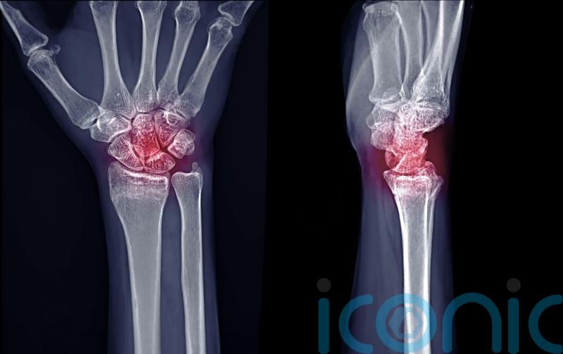 Up to one in three with rheumatoid arthritis ‘at risk of long-term opioid use’