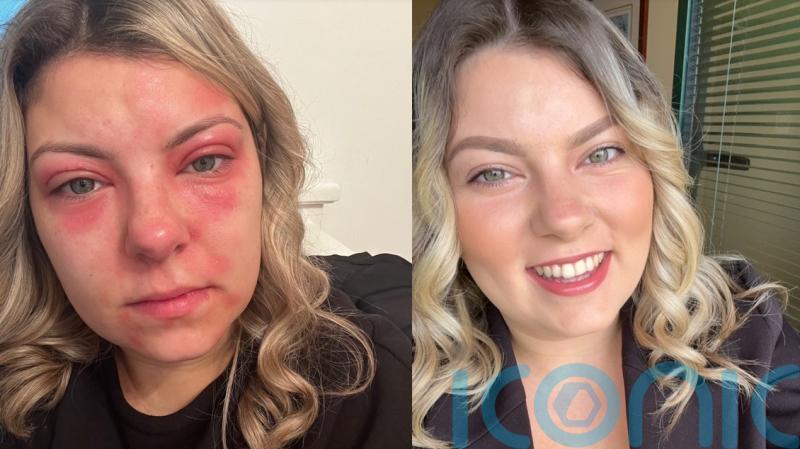 Mum who became a recluse after allergic reaction led to sore and flaky skin says cream ‘helped me get my life back’