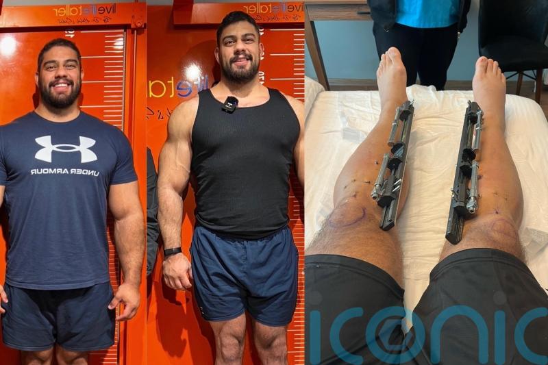 Dad of two spends &pound;86,000 lengthening his limbs to grow from 6ft to 6ft 7in so he feels &lsquo;on top of the world&rsquo;