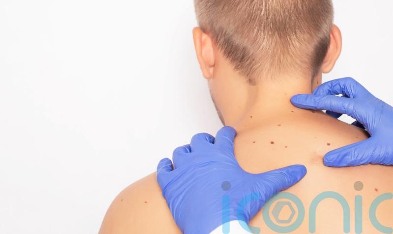 Smartphone camera lens technology to be used in skin cancer diagnoses