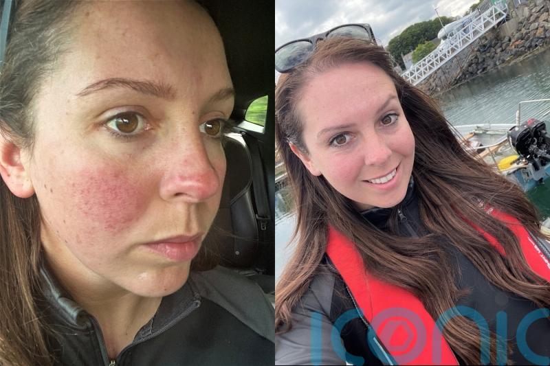 Mum whose ‘awful’ skin condition ‘put a downer’ on her pregnancy finds ‘miracle cure’ after bursting into tears in car