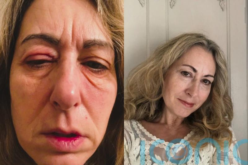 Mum who feared she was losing her sight when she woke up with her red swollen eyes ‘glued shut’ finds miracle cure