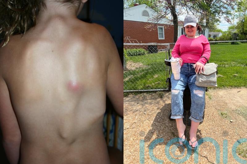 Blogger who is ‘growing second skeleton’ and can’t walk due to rare disorder hopes to start family and go swimming again