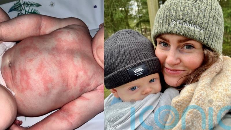 Mum who felt ‘helpless’ as her baby suffered sleepless nights with horrific rash praises ‘life-saver’ cream