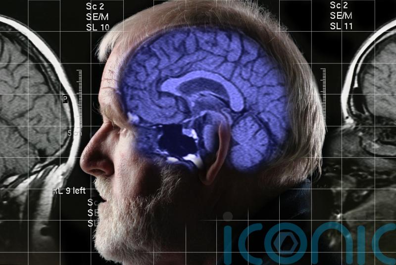 Why is this Alzheimer’s breakthrough so important?