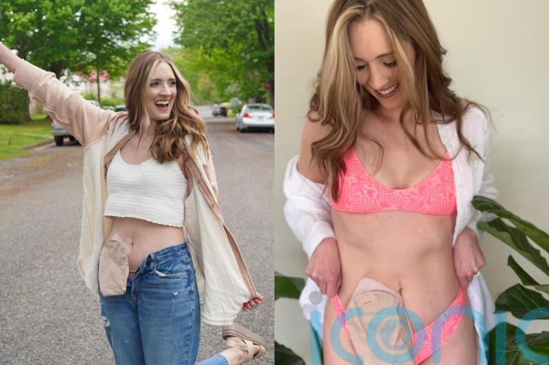 Mum with stoma bag poses in bikinis on social media to raise awareness after being given a ‘second chance at life’