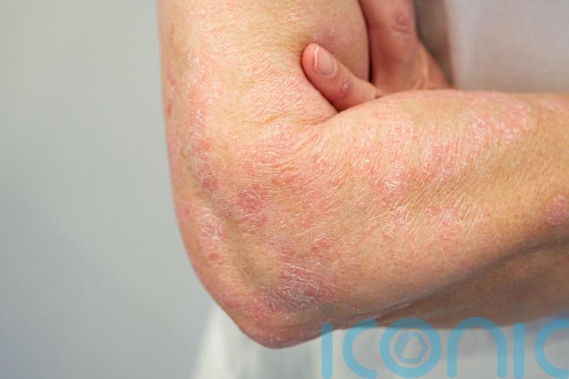 Psoriasis Awareness Month: Everything you need to know