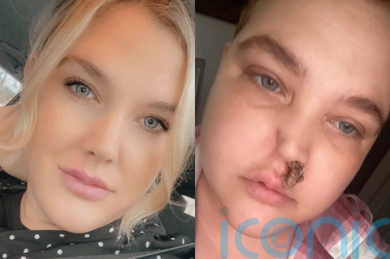 Mum pulling lumps of cartilage from nose afraid to show face in public after rare condition mistaken as infection