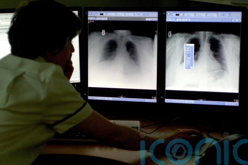 Computer modelling ‘could simplify lung cancer screening’