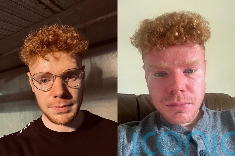 Man, 26, left with ‘acid burn’ rashes and 30 toilet trips per day after food poisoning turns out to be incurable disease