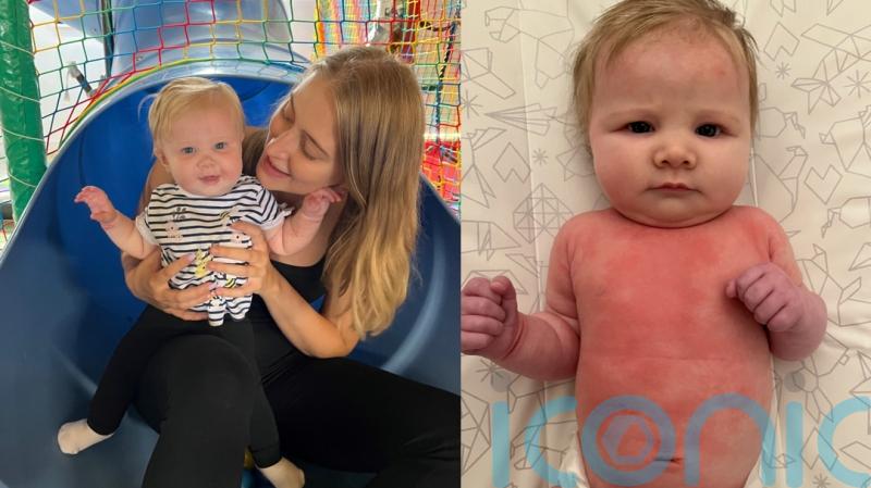 Mum whose baby suffered with eczema so bad it caused her to bleed found solution thanks to her 10,000 viewers on TikTok