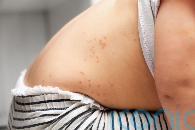 Childhood chickenpox vaccine recommended for use on the NHS