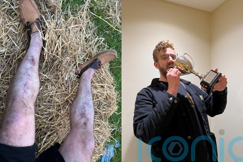 Man crowned shin kicking world champion on first try at the ancient sport aims for domination despite breaking two toes