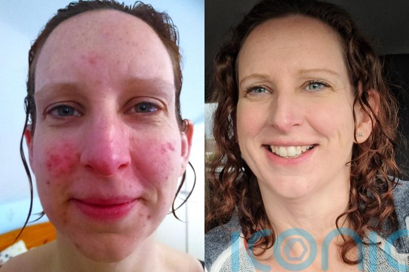 Mum left with red skin for months after face turned into ‘red-hot furnace’ cooking Christmas dinner finds miracle cure