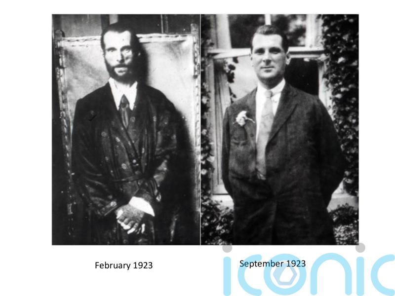 100 years since the first diabetes patient treated with insulin in England