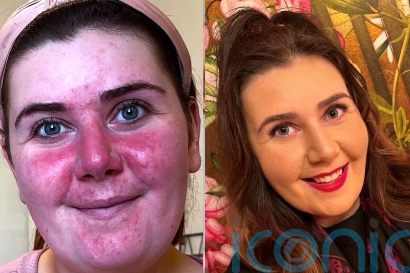 Mum who developed rosacea after giving birth, forcing her to avoid family photos and dread leaving house, finds cure
