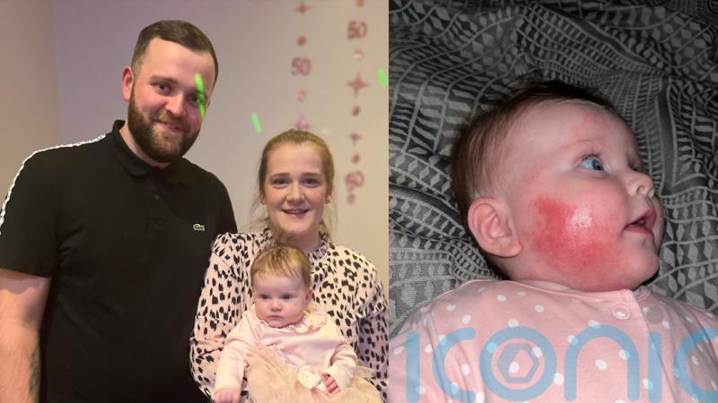 Mum who had sleepless nights to stop her baby scratching her sore and oozing skin due to eczema finds high street cure