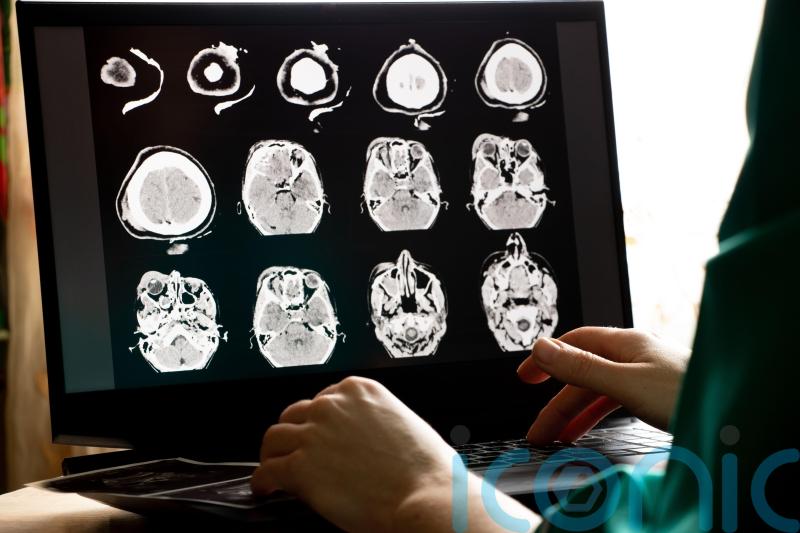 Longer term impact of sport-related brain injuries revealed by study