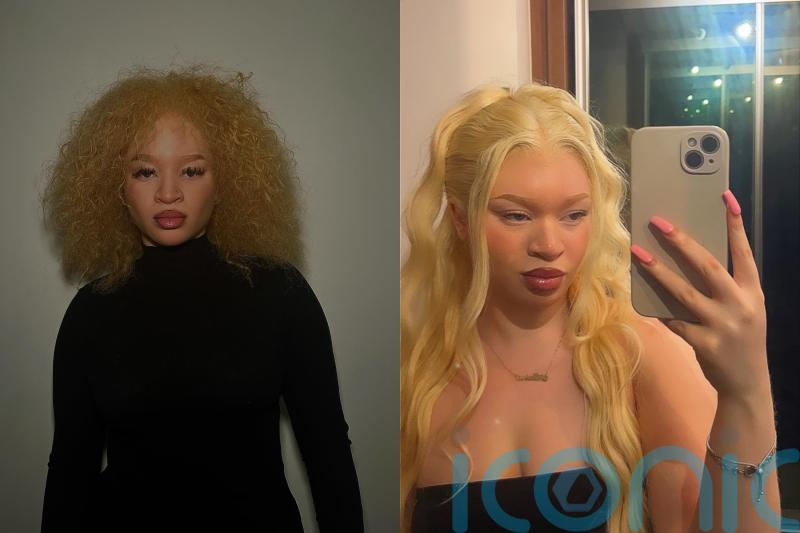 Albino woman picked on and fetishised in younger years now modelling at London Fashion Week and in Vogue Magazine