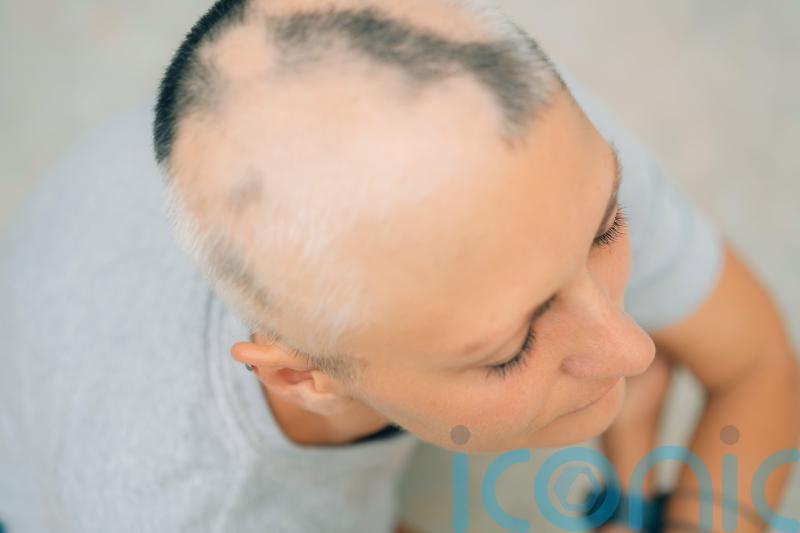 First alopecia treatment approved for NHS use