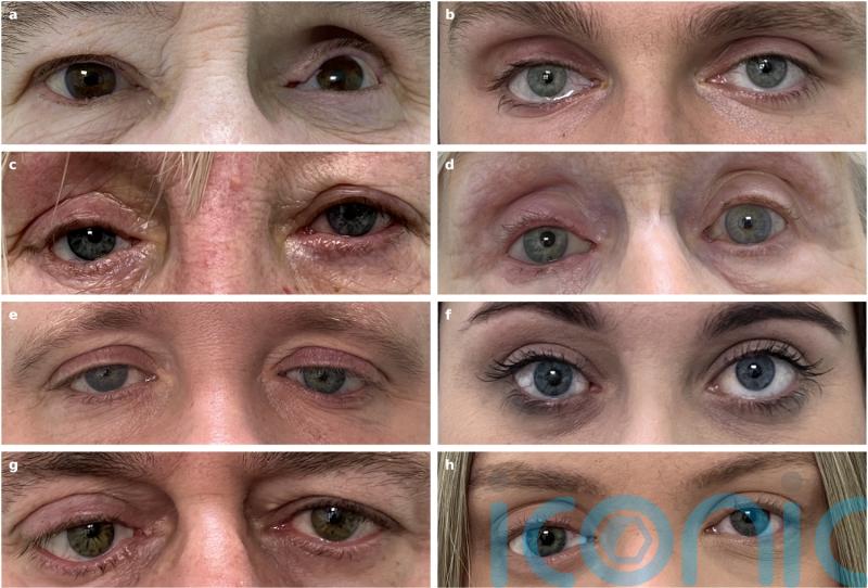 Researchers able to make better artificial eyes using 3D printing – study