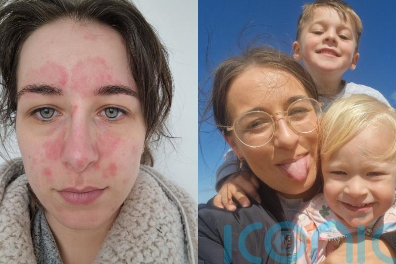 Mum battling psoriasis since school who faced staring and severe post-pregnancy flare up finds ‘life changing’ cure