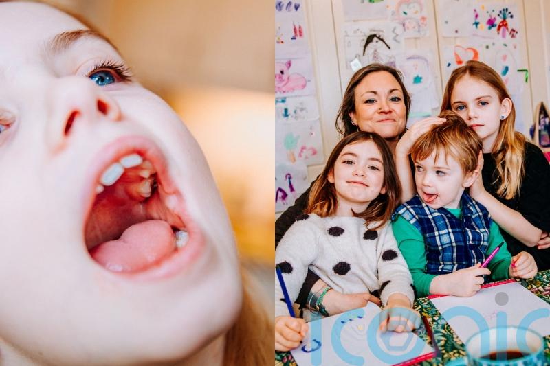 Frustrated mother waiting nearly two years for daughter’s ‘rotting’ tooth to be removed due to NHS waiting lists