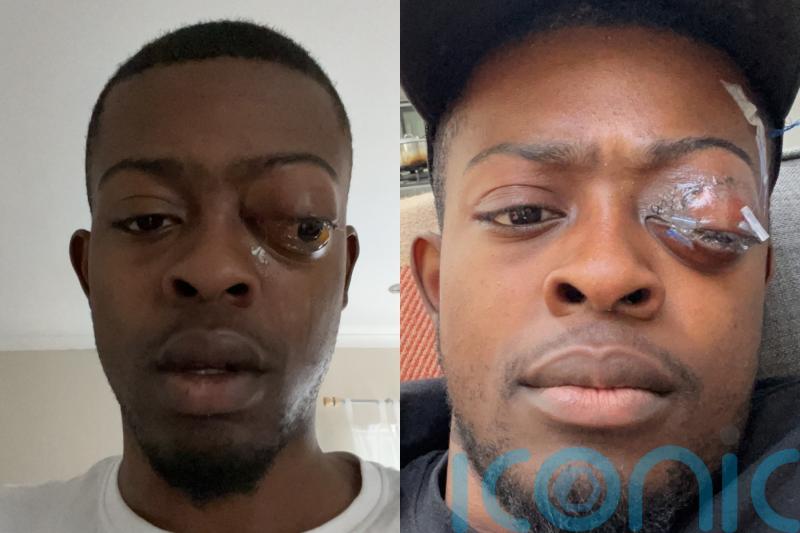 Man whose eye was ‘protruding from head’ says he visited hospitals nine times before cancer diagnosis