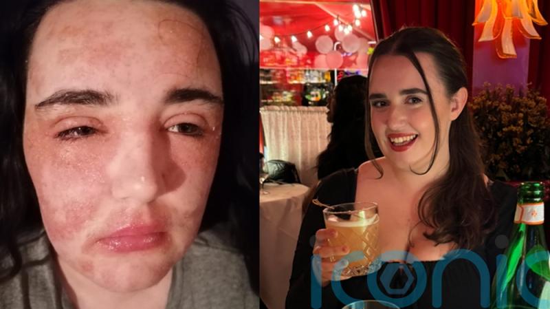 Student’s eczema sealed her eyes and mouth shut and turned her into a recluse but ‘miracle’ cure gave her new confidence